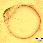 La rimozione dell’otturazione canalare nei ritrattamenti