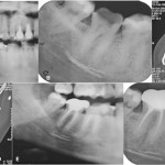 Diagnosi e terapia: parestesia del nervo alveolare inferiore Diagnosi e terapia: parestesia del nervo alveolare inferiore