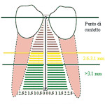 Utilizzo delle miniviti come ancoraggio ortodontico