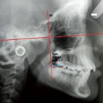 Previsione d’inclusione dei terzi molari e indicazioni alla loro estrazione