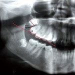 Dislocazione del terzo molare durante chirurgia: complicanze e soluzioni