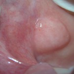 Rara neoformazione della mucosa geniena. Un case report neoformazione-della-mucosa-geniena-