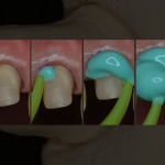 Impronta di precisione in protesi fissa: caratteristiche dei materiali