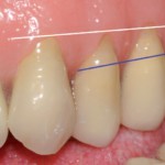 Fasi finali del trattamento protesico