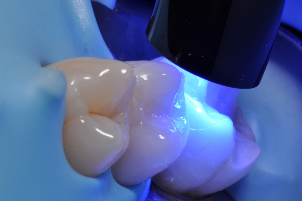 composito-nei-settori-posteriori