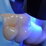 Il piano di trattamento in composito nei settori posteriori composito-nei-settori-posteriori