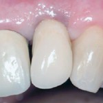 Carico immediato con impianti Neoss