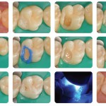 E’ ancora necessario abbattere lo smalto non sostenuto?