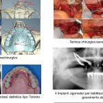 Trattamento delle estreme atrofie mascellari con impiego di impianti zigomatici e pterigoidei