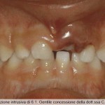 Lussazione intrusiva degli incisivi decidui superiori e sequele dei corrispettivi elementi permanenti