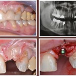 Il Carico Immediato nel Settore Frontale Superiore