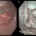 La cromomagnificazione endoscopica virtuale
