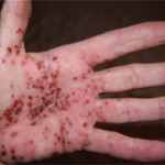 La sindrome Sapho patologia sistemica e manifestazioni mandibolari