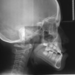 Thin-Plate Spline dei cambiamenti morfologici mandibolari