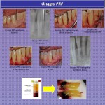 La PRF e EMD nel trattamento dei difetti infraossei parodontali a 2-3 pareti