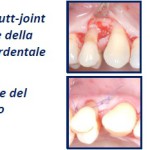 Guarigione precoce di difetti intraossei trattati con Single Flap Approach (SFA)