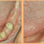 Utilizzo dell’ozonoterapia nel trattamento delle osteonecrosi da bifosfosnati dei mascellari