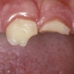 Studio clinico retrospettivo sull’esito di pulpotomie eseguite con MTA