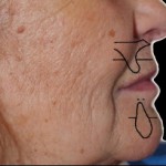 Influenza delle riabilitazioni protesiche implanto-supportate