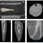 Analisi della Costrizione Apicale con Microtac e Sezioni Anatomiche