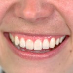 Parodontite e diabete