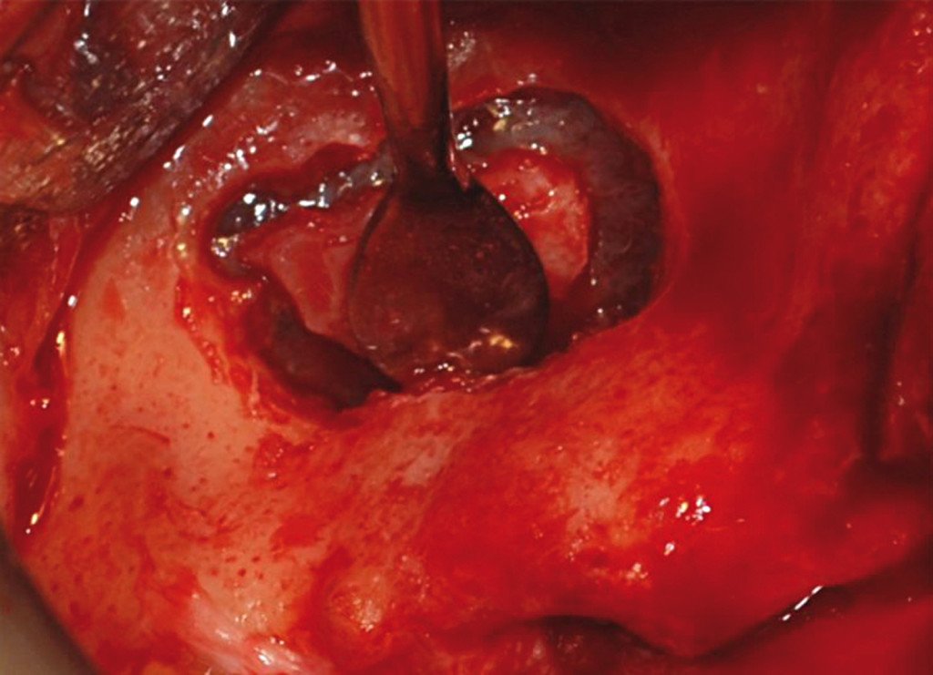 anatomia seno mascellare