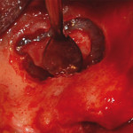 Anatomia e struttura del seno mascellare anatomia seno mascellare
