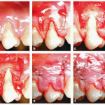 Recessioni gengivali