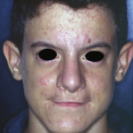 Importanza della finalizzazione estetica-restaurativa nel trattamento di pazienti affetti da labio-palato-schisi trattati ortodonticamente