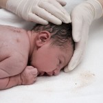 Labioschisi e palatoschisi unilaterale: influenza sulla crescita facciale e problematiche ortodontiche