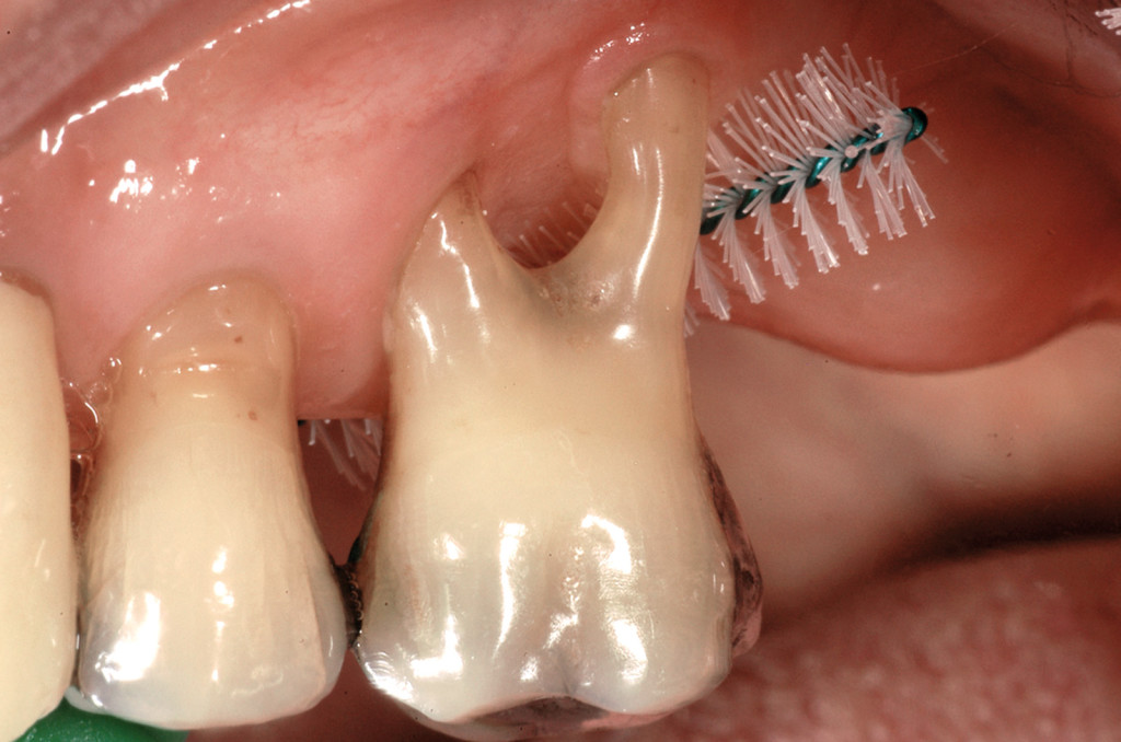 Una corretta igiene domiciliare e terapia di supporto parodontale hanno permesso il mantenimento di questo elemento per più di 15 anni. Cartella parodontale