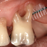 Perdita dei molari per parodontite: il ruolo delle forcazioni esposte Una corretta igiene domiciliare e terapia di supporto parodontale hanno permesso il mantenimento di questo elemento per più di 15 anni. Cartella parodontale