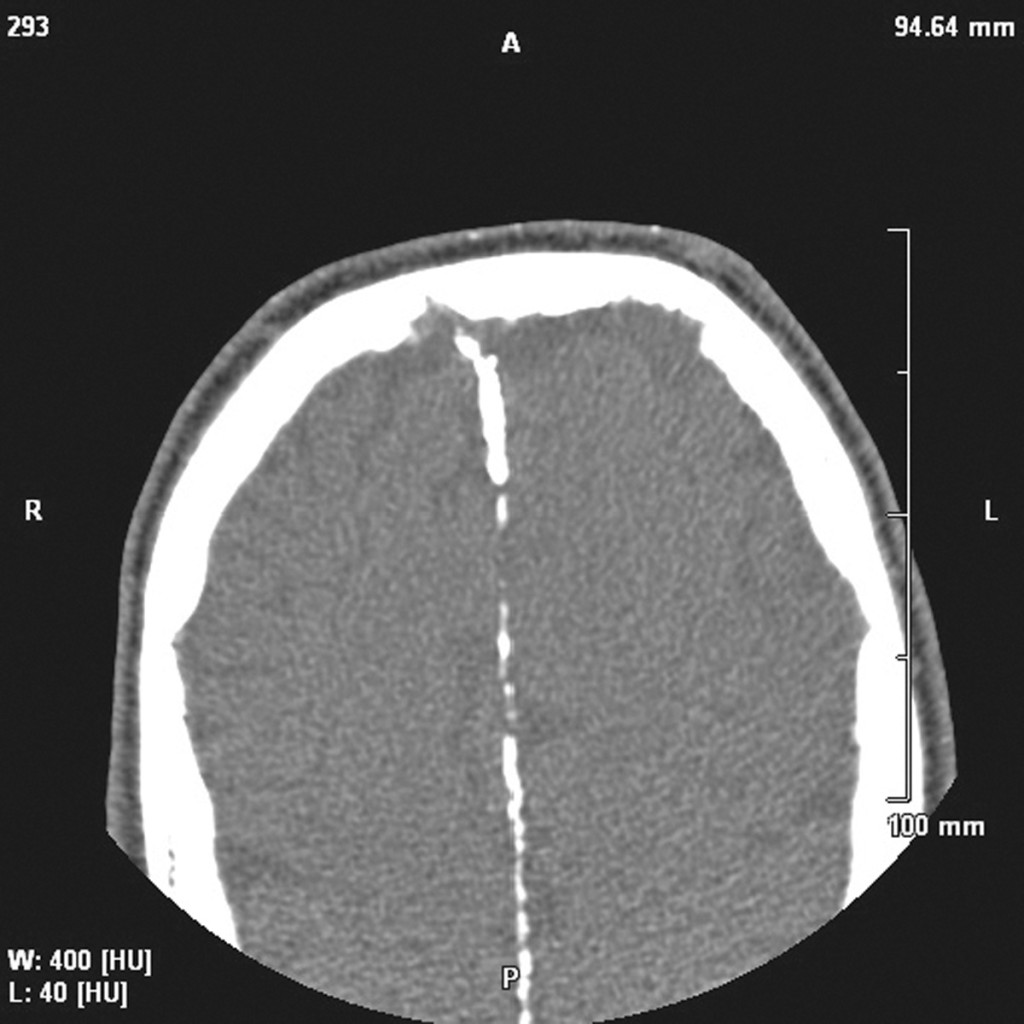 sindrome-di-gorlin-goltz