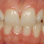 Faccette in ceramica integrale