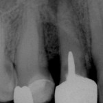 Endodonzia, conservativa e ritrattamenti, tre video arricchiscono il nostro sito