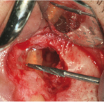 Risoluzione di una lesione periapicale con endodonzia chirurgica DM_il dentista moderno_lesione periapicale_apicectomia_trattamento e risoluzione