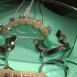 Tre video, dallo splintaggio al preplating passando per l’impianto