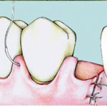 Sutura sospesa doppia sutura doppia sospesa
