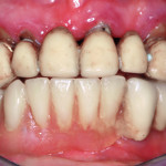 Carico immediato full arch mascellare e mandibolare: un nuovo approccio chirurgico e protesico