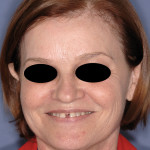 Ortodonzia linguale e ortodonzia con allineatori, due casi a confronto