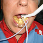 Trattamento dell’osteonecrosi da bisfosfonati dei mascellari mediante ozono medicale gassoso e in sospensione oleosa Risultati di uno studio di fase I-II condotto presso l’Istituto Nazionale Tumori di Milano trattamento-osteonecrosi-bisfosfonati-ozono-