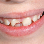 Restauro di IV classe in condizioni di isolamento complesse Un approccio alternativo per un risultato estetico e funzionale predicibile Case report