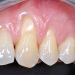 Trattamento estetico di recessioni gengivali multiple con approccio conservativo-parodontale