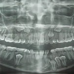 Manifestazioni orali dell’ipotiroidismo: case report