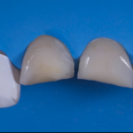 Epidemiologia di traumi dentali, fratture e avulsioni traumi dentali epidemiologia direct-restoration-frontal-teeth