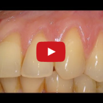 Gingival Recession treatment utilizing a connective tissue graft gingival-recession-treatment-connective-tissue-graft recessione gengivale mucogengivale