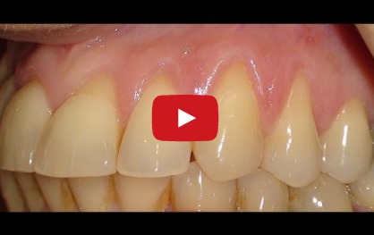 gingival-recession-treatment-connective-tissue-graft recessione gengivale mucogengivale