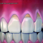 Tecnica chirurgica Pinhole: prospettive storiche