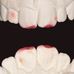 Riabilitazione estetica conservativa del gruppo frontale superiore