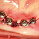 Osteointegrazione nel paziente geriatrico